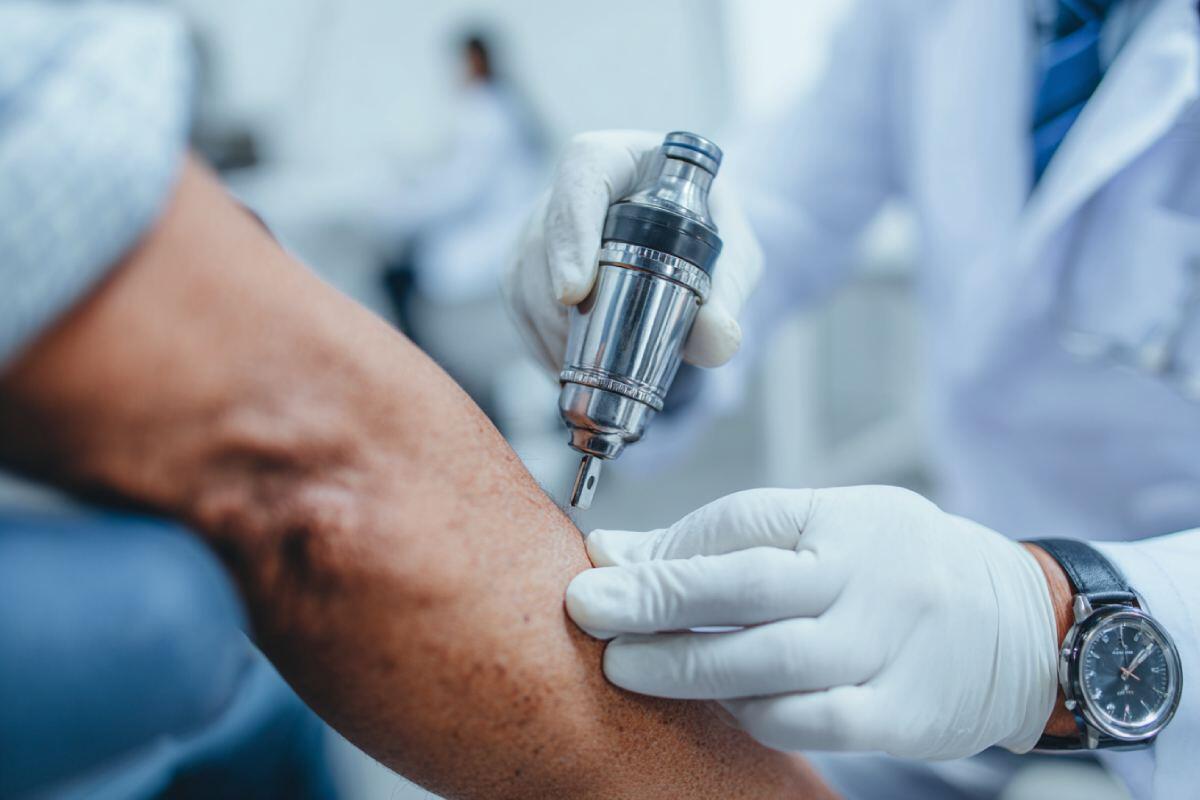 Cómo detectar el cáncer de piel en climas cálidos como Cartagena o Santa Marta